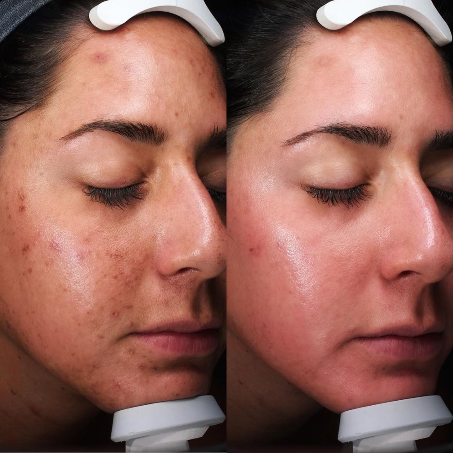 HydraFacial Deluxe for Face and Neck