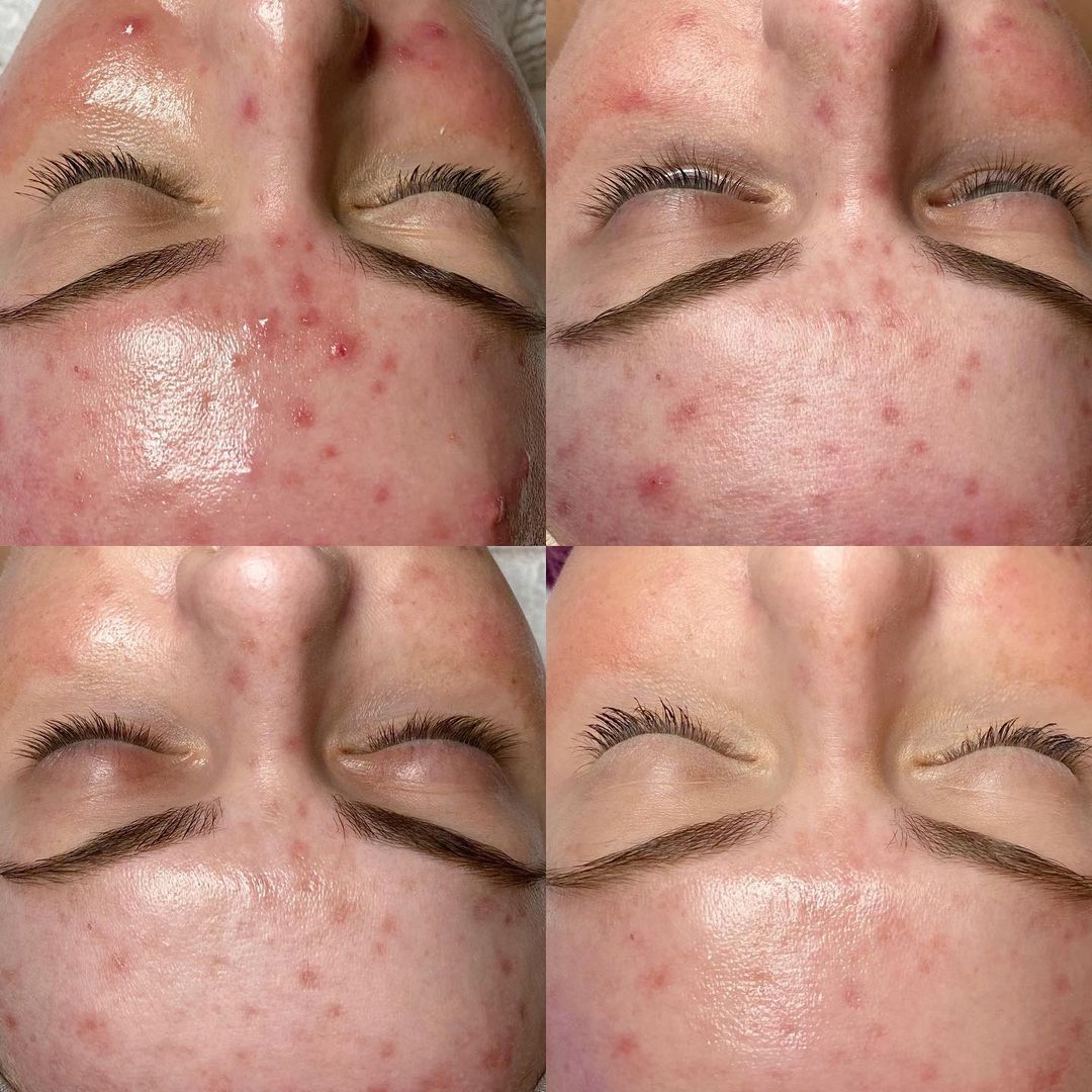 HydraFacial Deluxe for Face and Neck