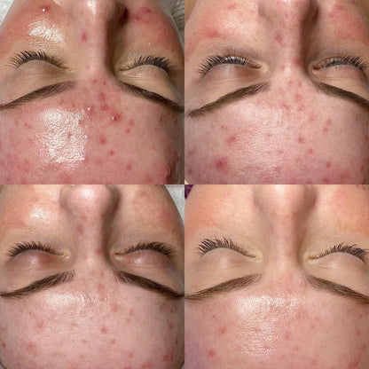 HydraFacial Deluxe for Face and Neck