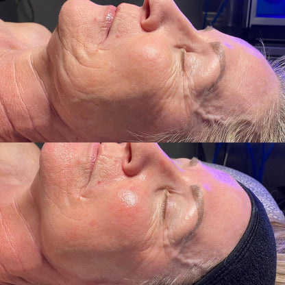 HydraFacial Deluxe for Face and Neck