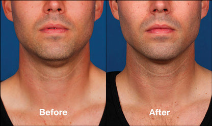 Kybella Treatment Package