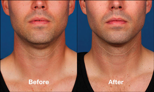 Kybella Treatment Package