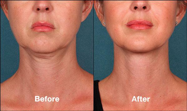 Kybella Treatment Package