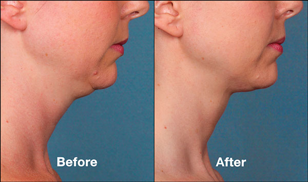 Kybella Treatment Package