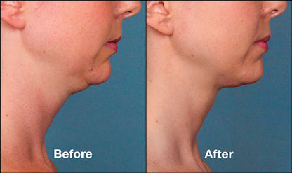 Kybella Treatment Package