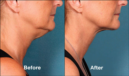 Kybella Treatment Package