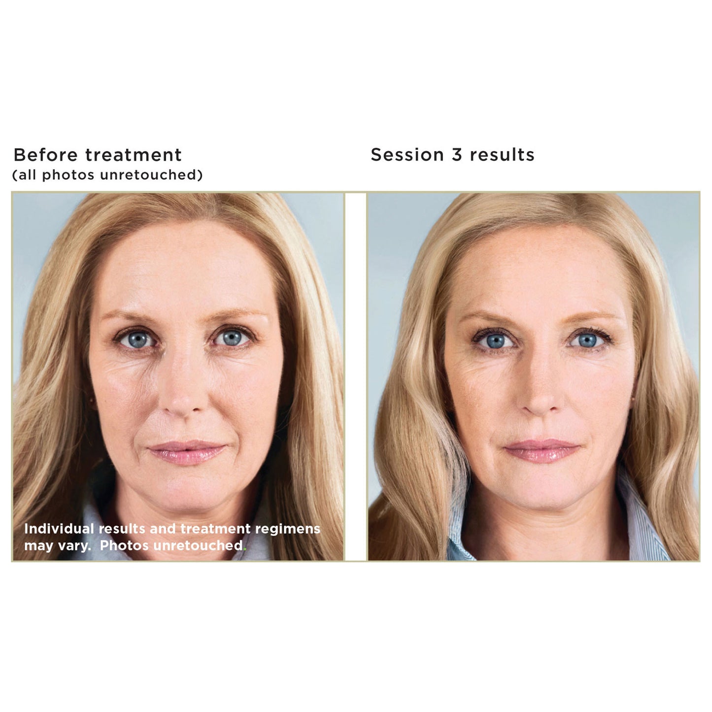 Sculptra Treatment Package