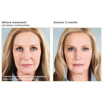 Sculptra Treatment Package