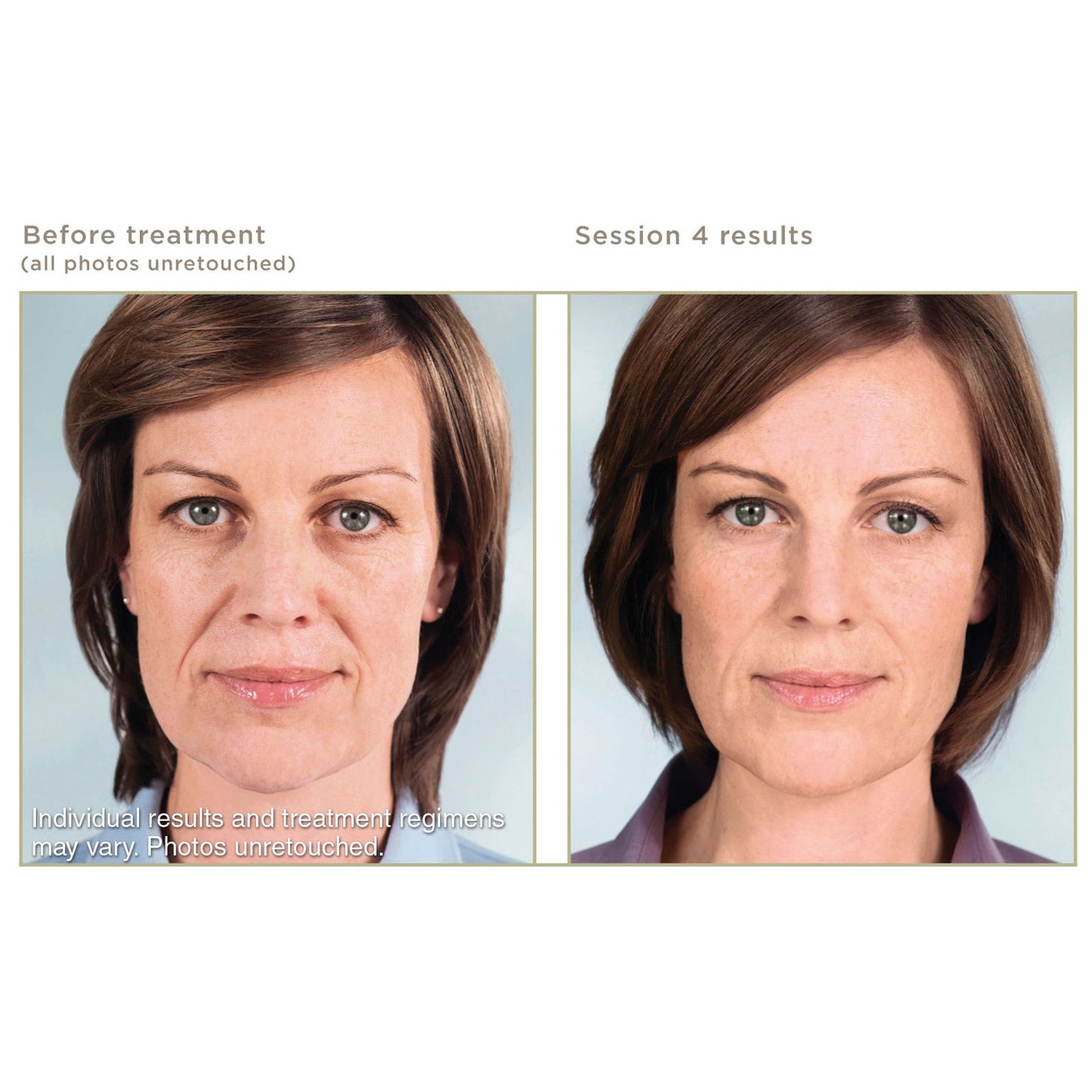 Sculptra Treatment Package