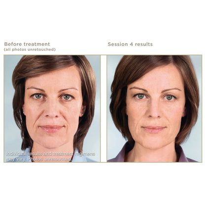Sculptra Treatment Package