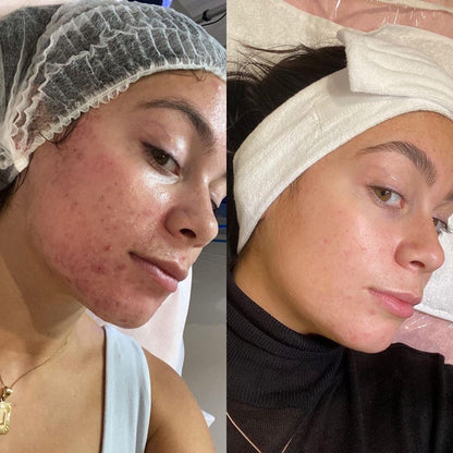 HydraFacial Deluxe for Face and Neck