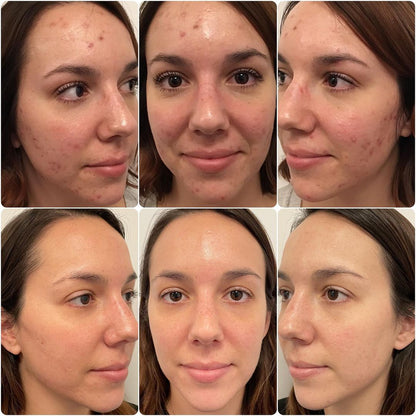 HydraFacial Deluxe for Face and Neck