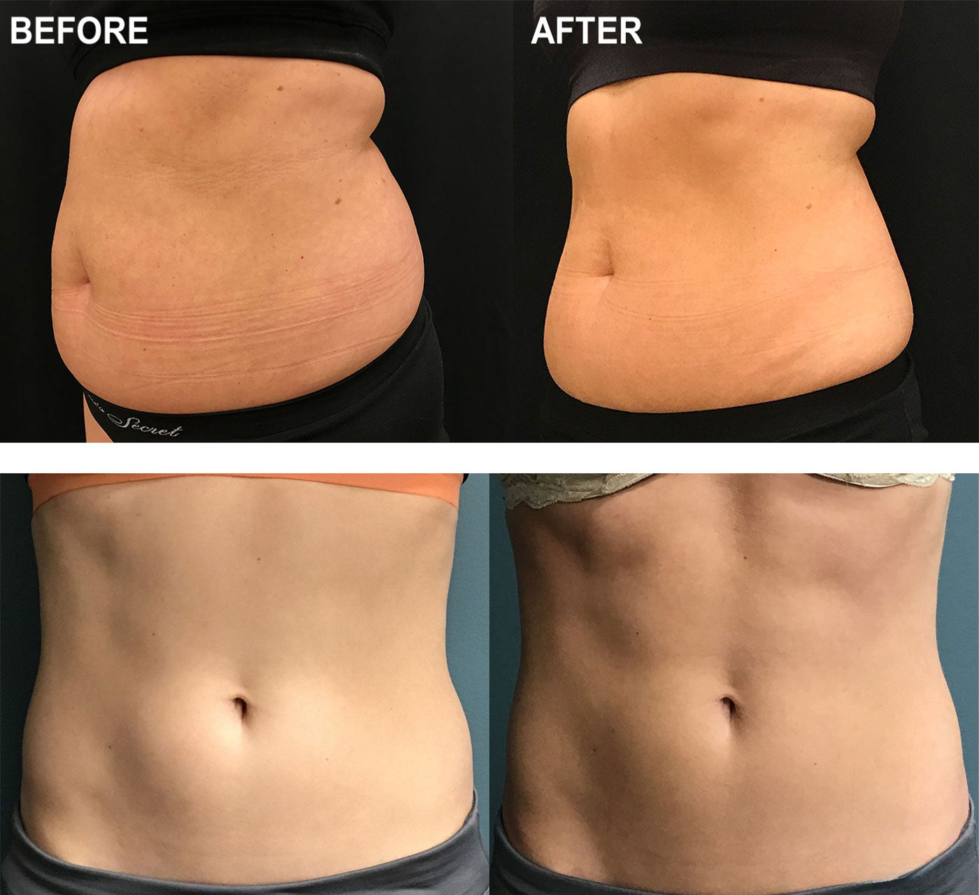 EvolveX Body Contouring Package