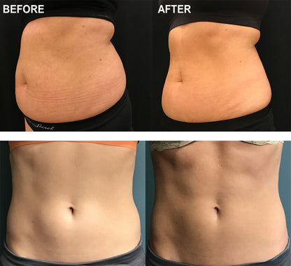 EvolveX Body Contouring Package